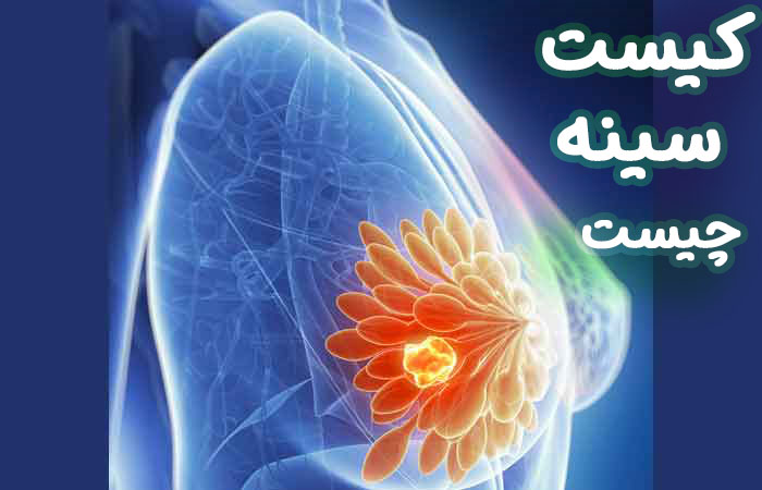 کیست سینه  