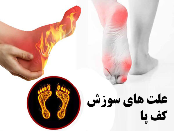 داغ شدن کف پا