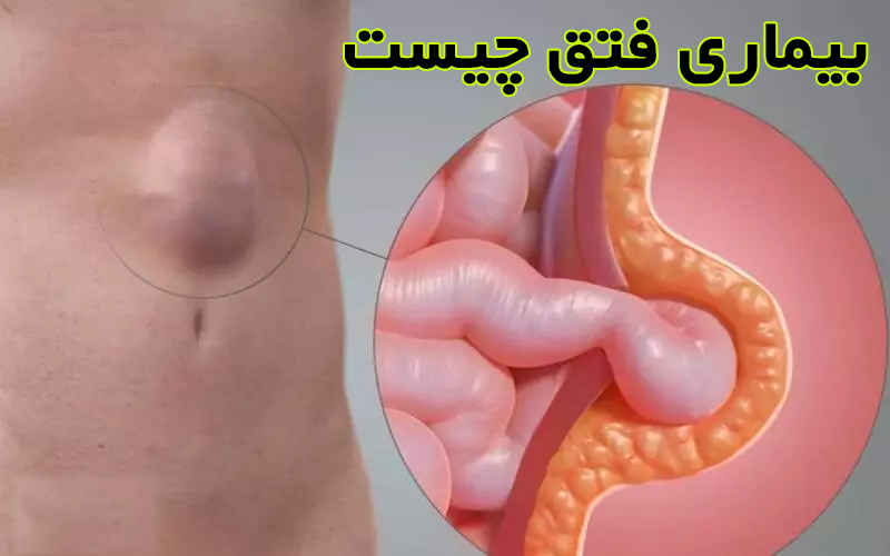 همه چیزهایی که باید درباره بیماری فتق بدانید