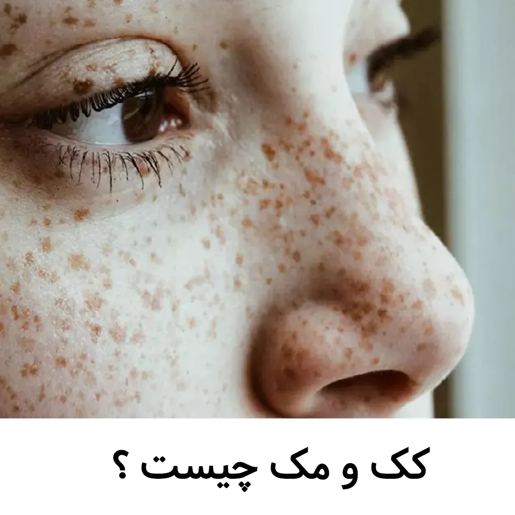 کک و مک  پوست